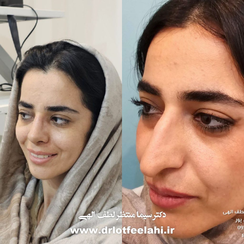 جراح بینی طبیعی