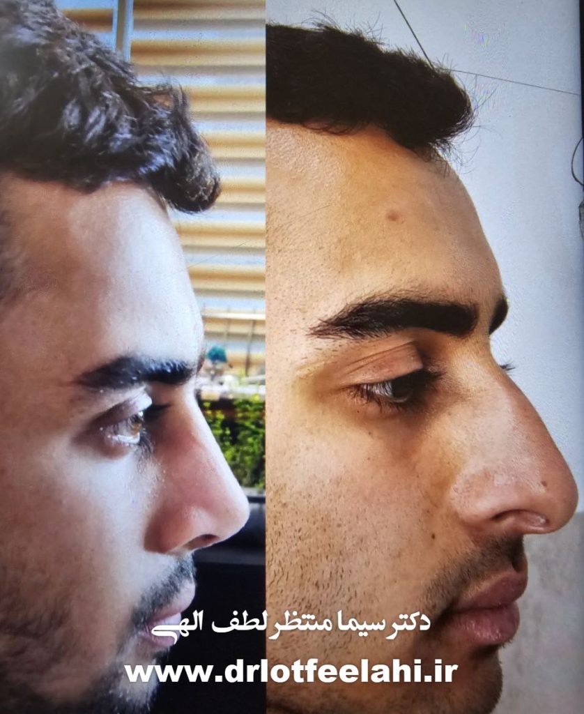 جراحی بینی توسط دکتر گوش حلق و بینی