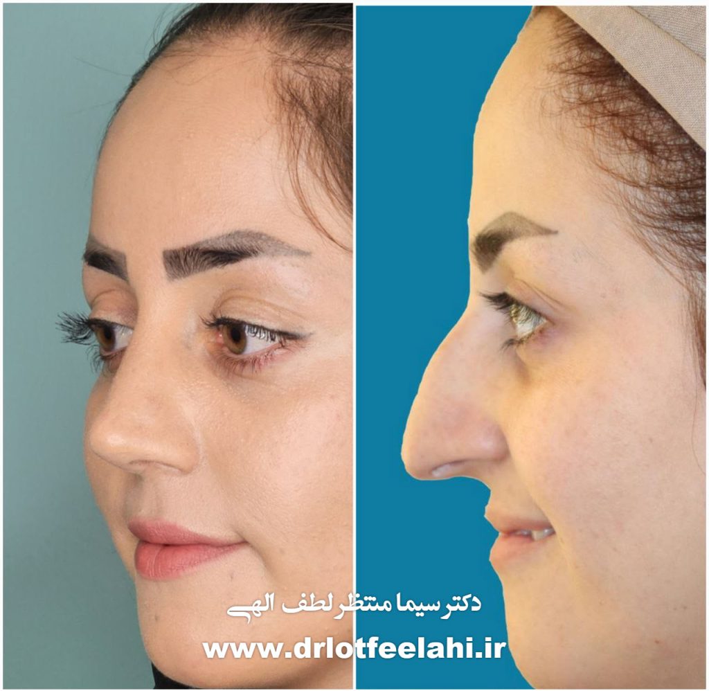 نمونه کار جراحی بینی _ دکتر سیما منتظر لطف الهی