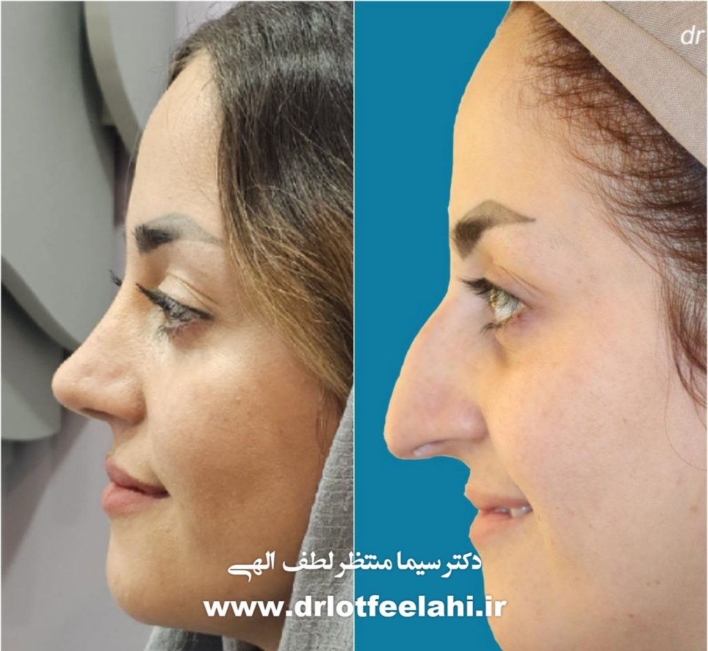 جراحی ترمیمی بینی