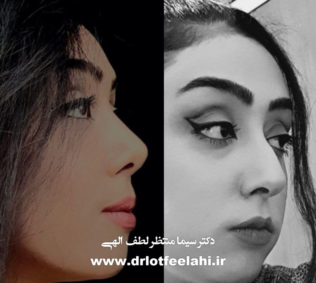 مزایای جراحی بینی بر تنفس