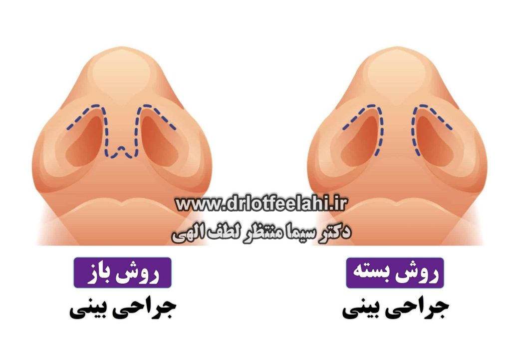 تفاوت جراحی بینی باز یا بسته دکتر سیما منتظر لطف الهی