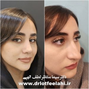 هزینه جراحی بینی