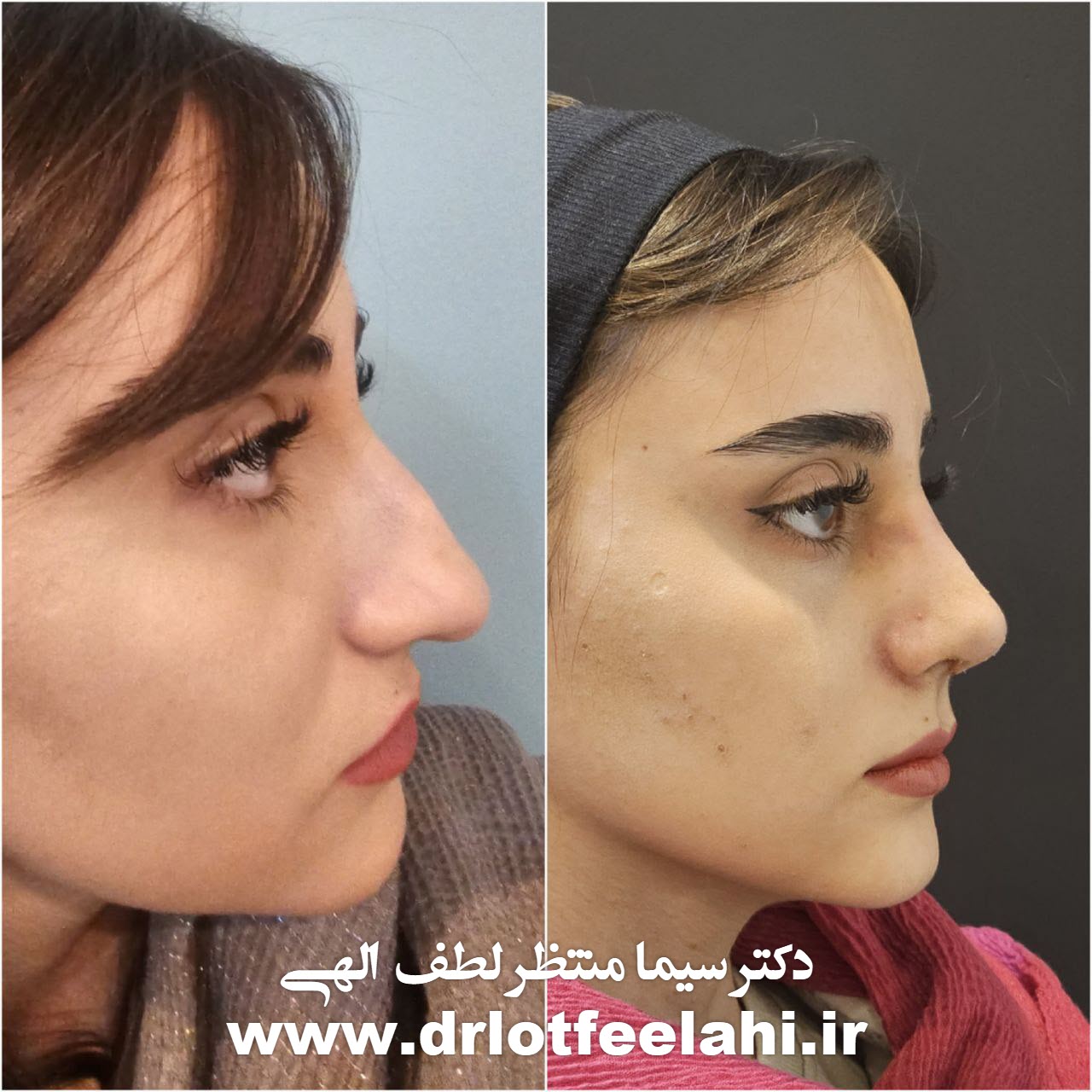 هزینه جراحی بینی
